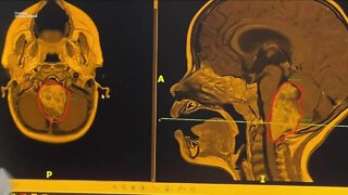 Pinellas County toddler diagnosed with golfball-sized brain tumor