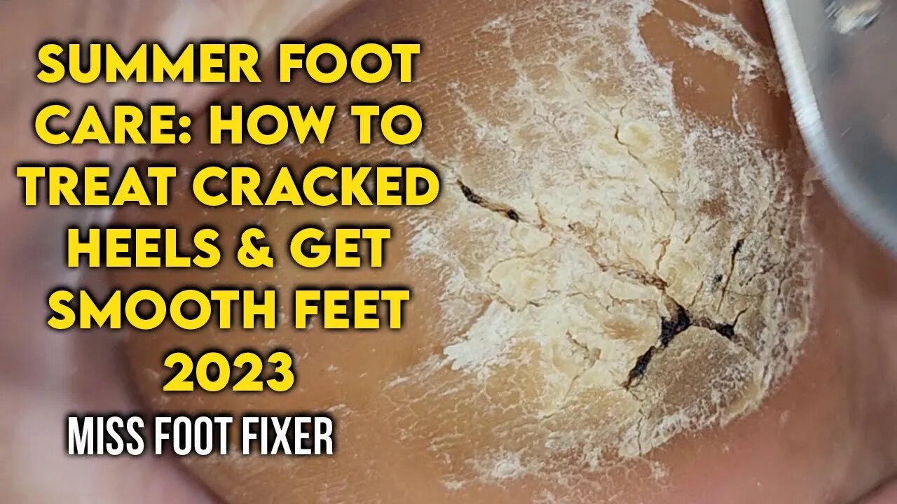 SATISFYING THICK FOOT CALLUS REMOVAL BY MISS FOOT FIXER MARION YAU 