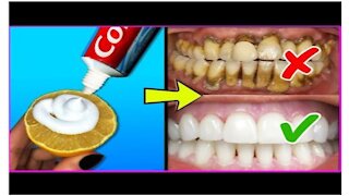 Teeth Whitening At Home In 5 Minutes || How To Whiten Your Yellow Teeth Naturally
