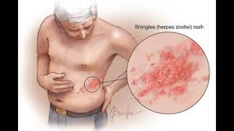Shingles Explained-What it is and how to treat it!