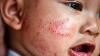 What Causes Acne In Babies?