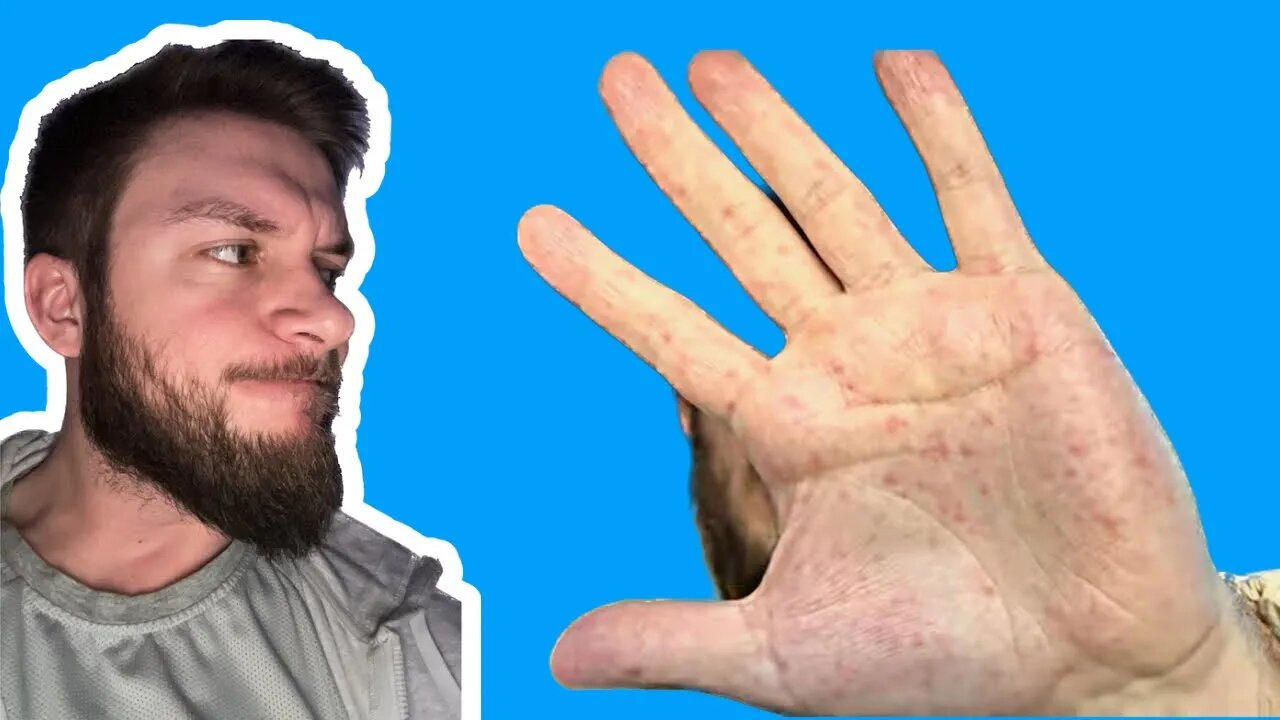 small-red-bumps-on-hands-eczema