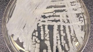 'Superbug' fungus Candida auris found in 76-year-old Oakland County man