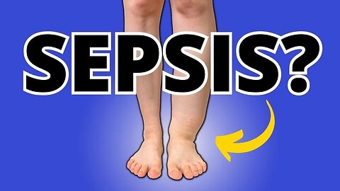 Alert! Foot/Ankle Swelling & Edema Can Cause Serious Sepsis; Know This