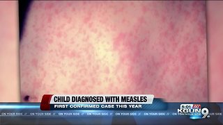 First Confirmed Case of Measles in Arizona for the year
