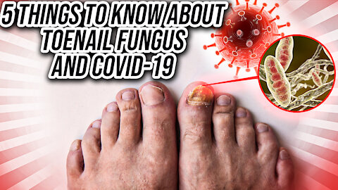 5 Things To Know About Toenail Fungus And COVID-19
