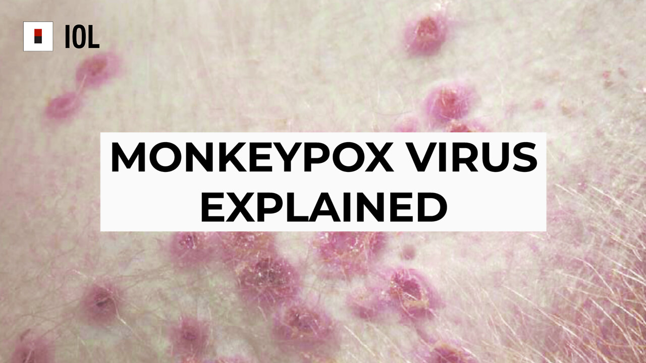 What Is Monkeypox? A Microbiologist Explains What's Known About This Disease