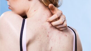 Everything You Need To Know About Back Acne