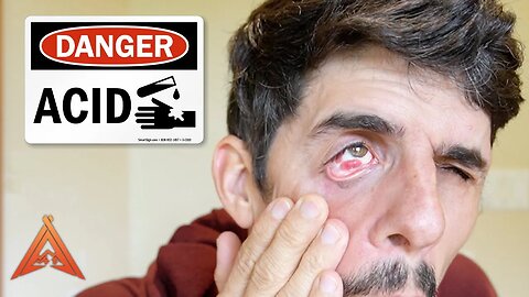 How Acid Destroyed My Eye