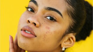 Acne vs Pimples, What’s The Difference?