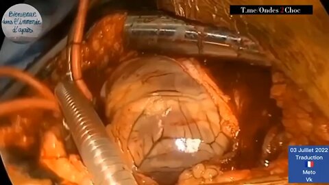 Giant clot pulled out of beating heart of vaXXXed patient