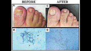 toenail fungus cures