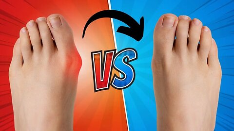 How To Fix A Bunion In 5 Steps