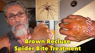 Brown Recluse Spider Bite Treatment Part 1 | Dr. Robert Cassar