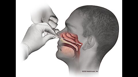 Prueba COVID-19 por la nariz tiene ÓXIDO DE ETILENO que causa cáncer al cerebro, linfático, leucemia