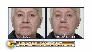 Amazing Results with Plexaderm