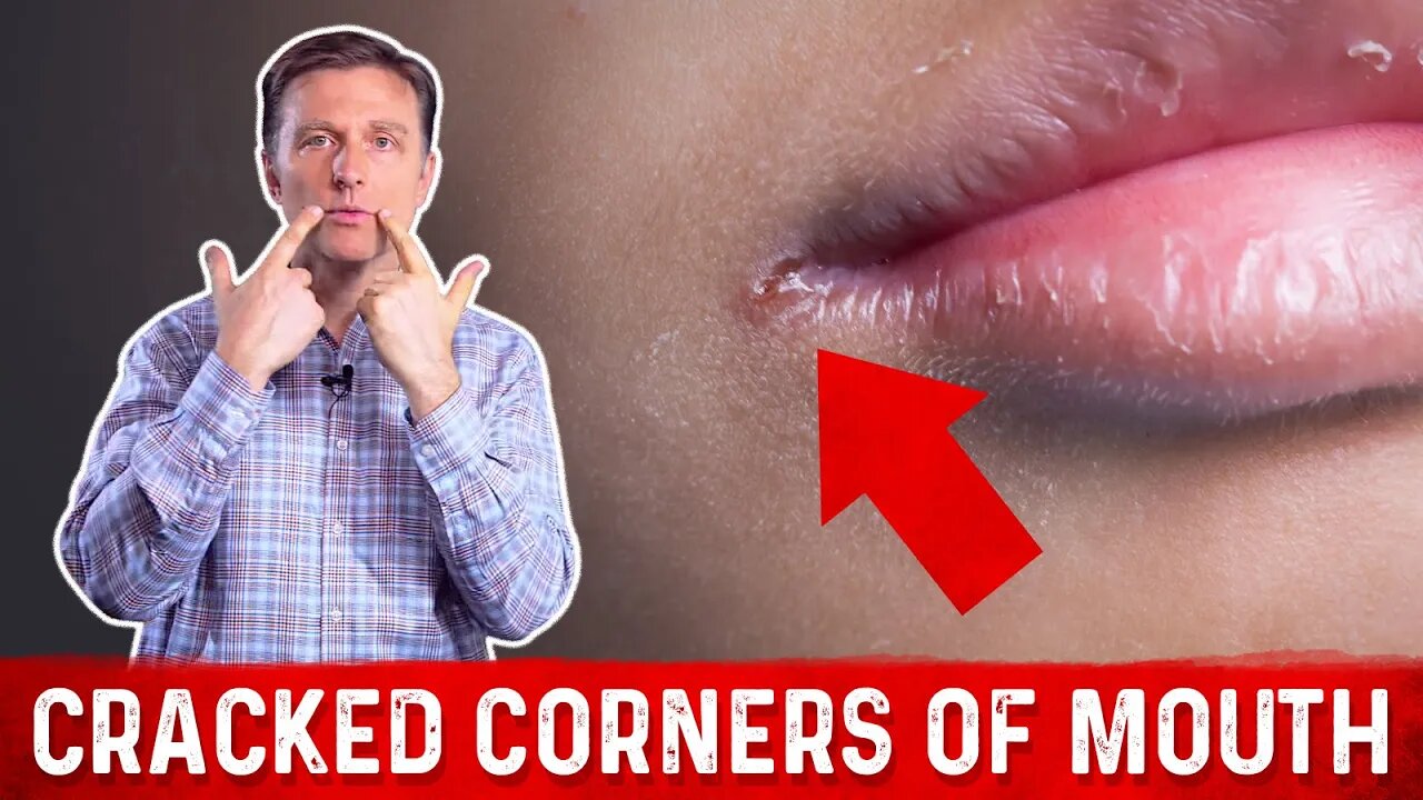 what-causes-cracked-corners-of-mouth-how-to-get-rid-of-angular