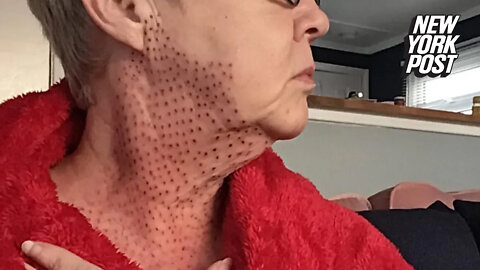 Beauty treatment 'nightmare': I got a procedure to fix my double chin and ended up with 'lizard' neck