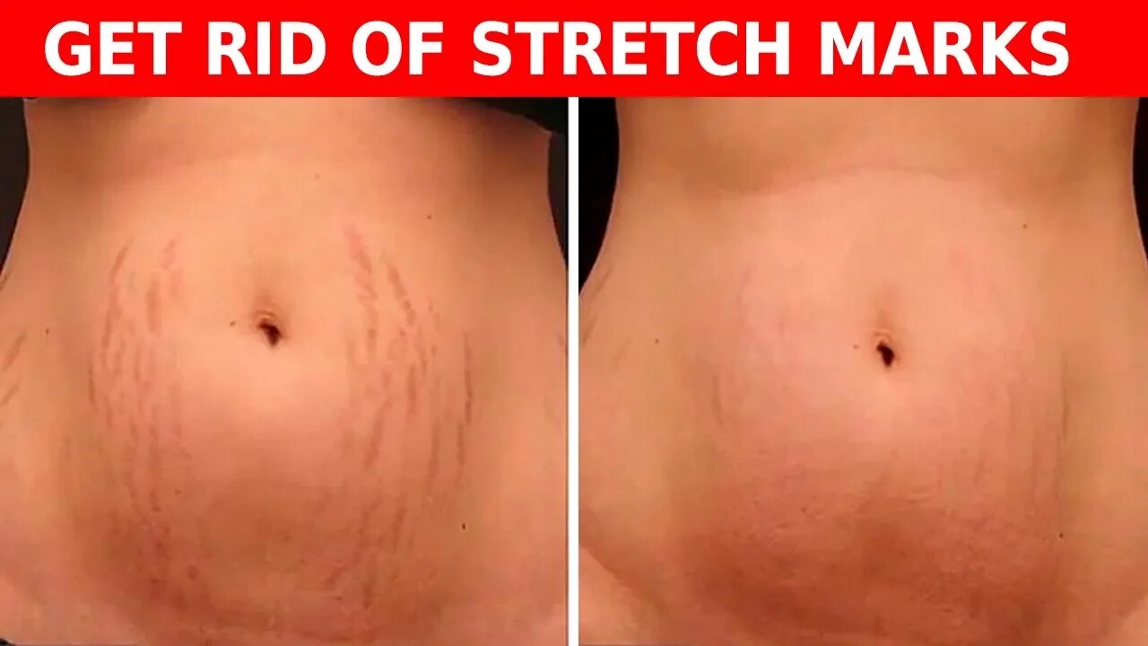 make-stretch-marks-disappear-with-these-easy-steps