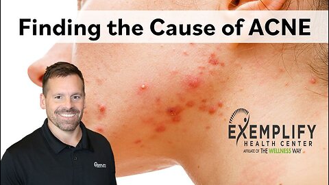 Finding the Cause of ACNE