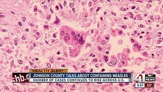 Johnson County Health Department talks about containing measles