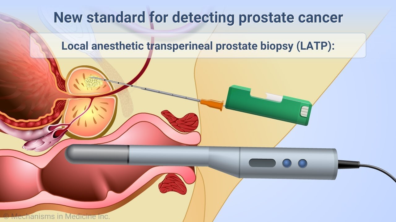 Transperineal Prostate Biopsies Under Local Anesthesia