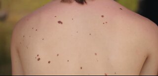 Dermatologist shares warning signs of melanoma