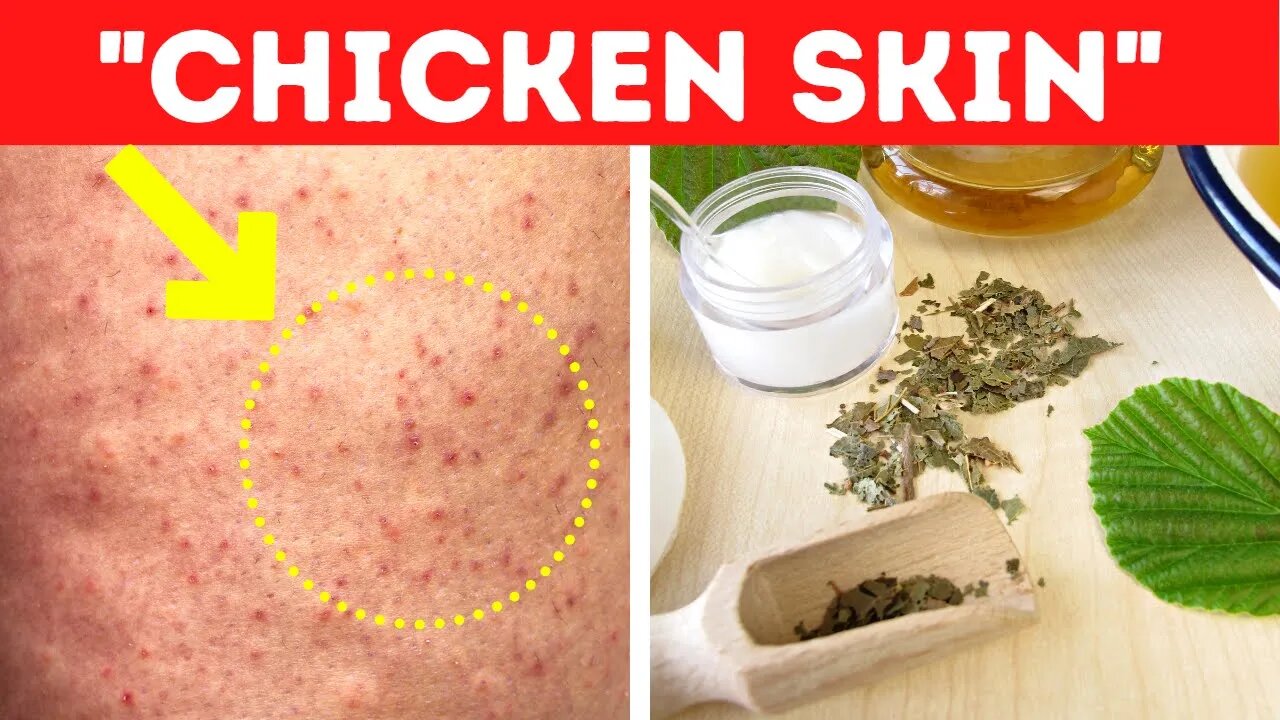Heres How To Get Rid Of Chicken Skin Fast Keratosis Pilaris