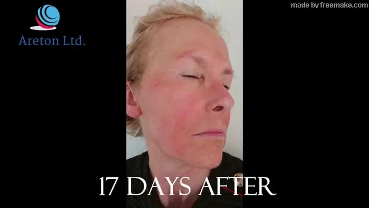 Areton Plasma Treatment Jaw Line And Under Eyelid Tightening For