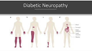 Diabetic Neuropathy - Natural Treatment