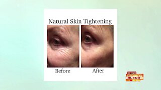 Tighten Skin Without Surgery