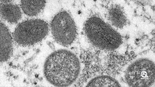 Presumptive case of monkeypox probed in South Florida