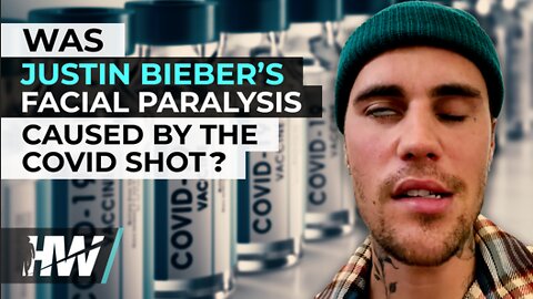 Justin Bieber's post-vax facial paralysis
