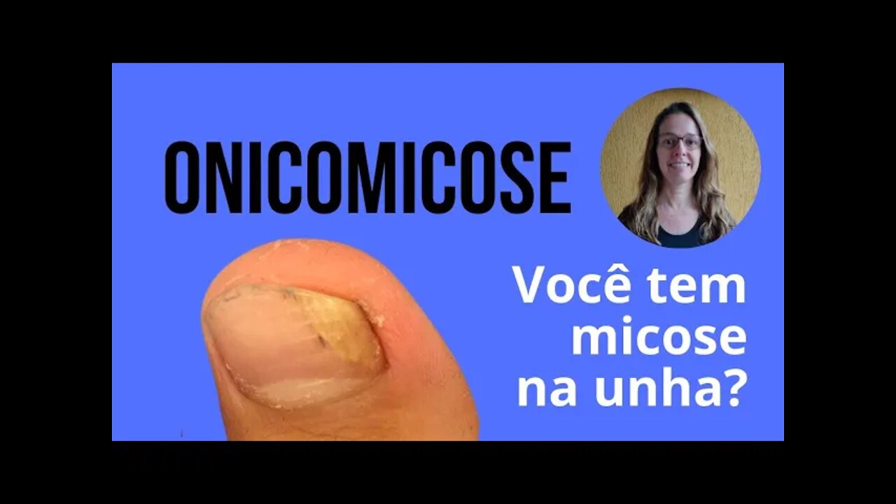 Tudo Sobre Onicomicose Micose De Unha Unheira