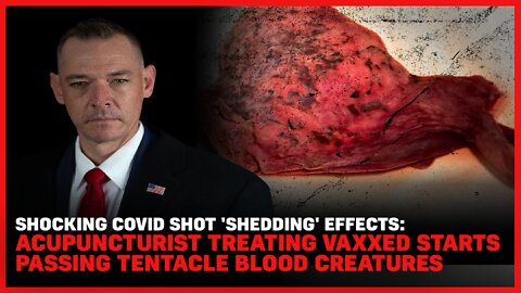 Shocking Covid Shot 'Shedding' Effects: Acupuncturist Treating Vaxxed Starts Passing Parasites
