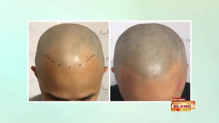 Non-Surgical Solution for Hair Loss
