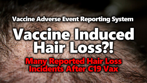 VAERS: Many Concerning Reports Of Massive Hair Loss/ Balding After C19 Vaccines (Part 1)