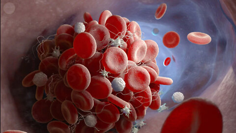 Coaguli di globuli rossi nel sangue a seguito del vaccino