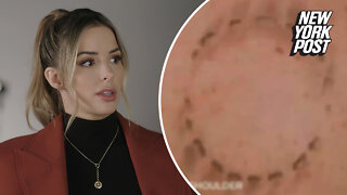 Armie Hammer docuseries to remove bite mark photo after investigation
