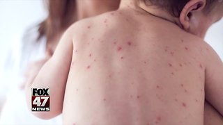 Confirmed measles cases at 34 in Michigan