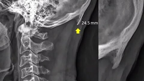 Are Cell Phones Mutating the Shape of Our Bones?