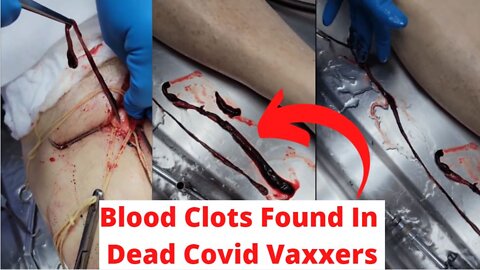 Unbelievable Blood Clots Found In Man Dead From Covid Vaccine