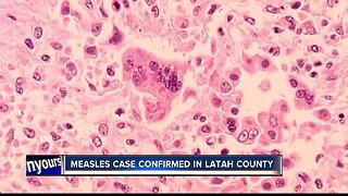First Idaho measles case since 2001 confirmed