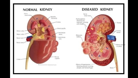 How To Survive Kidney Disease and A Cure