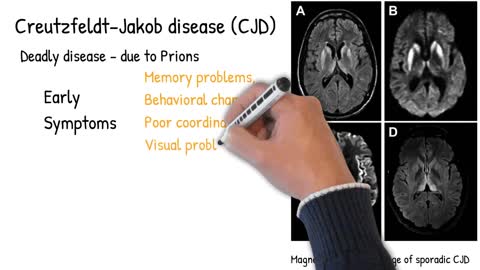 Prion Disease - Deadliest Disease. Creutzfeldt–Jakob disease symptoms, causes and prognosis