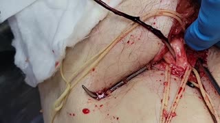 Unbelievable blood clots: video from embalmer Richard Hirschman