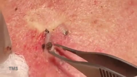 Back cystic acne extraction blackheads milia whiteheads pimple-popping