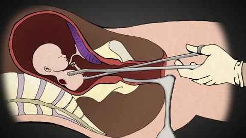 A visualization to an Abortion process