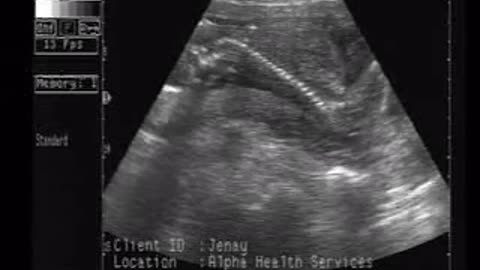 Ultrasound: Baby in the Womb - FETUS means LITTLE ONE!
