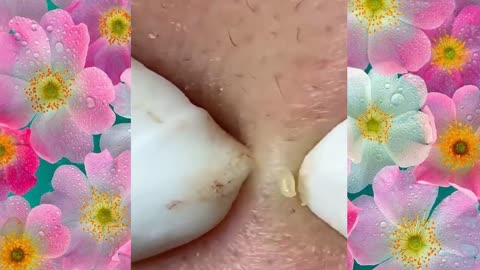 big-cystic-acne-blackheads-extraction-blackheads-milia-whiteheads-removal pimple-popping
